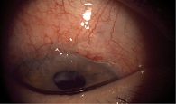 Рис. 6. Состояние глазного яблока через две недели после хирургического вмешательства