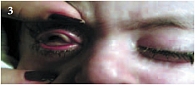 Рис. 3. Внешний вид больного до лечения (видны плотные, сероватые наложения на тарзальной конъюнктиве, выраженный отек и гиперемия век и конъюнктивы, общее раздражение глазных яблок, помутнение в оптической части роговицы справа)