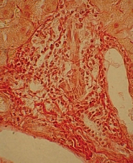 Рис. 4. Деструкция мелких желчных протоков и пролиферация клеток эпителия 