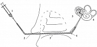 Рис. 1. Схематическое изображение микрокатетера, установленного в устье слуховой трубы