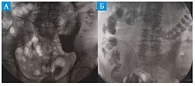 Рис. 2. Зондовая энтерография, выполненная на пятые сутки после гастропанкреатодуоденальной резекции у пациентов группы сравнения (А) и основной группы (Б). А – умеренный пнематоз петель тонкой кишки, рельеф сглажен, в желудке большое количество жидкости.