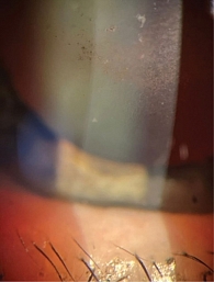 Рис. 12. Биомикроскопическая картина роговой оболочки правого глаза