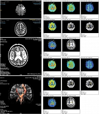 Рис. 11. МРТ (в том числе трактография) головного мозга пациентки Д., 67 лет, острый период ишемического инсульта в бассейне левой средней мозговой артерии