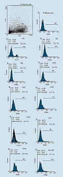 Рисунок 2. Иммунофенотип мононуклеонарных лейкоцитов плевральной жидкости больных раком яичников до проведения аллогенной LAK-иммунотерапии