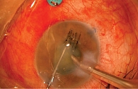 Рис. 1. Факоэмульсификация катаракты без имплантации интраокулярной линзы