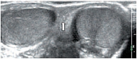 Рис. 2. Эхограмма мошонки ребенка 1 года. Поперечное сканирование. Стрелкой указана срединная перегородка мошонки