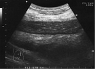 Рис. 1. МРТ: узловое новообразование в левой заушной области, прорастающее в сосцевидный отросток, окутывающее наружный слуховой проход, прорастающее в заднюю черепную ямку