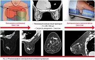 Рис. 2. КТ-маммография с внутривенным контрастированием