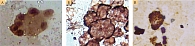 Рис. 4. ИЦХ-исследование метастатического экссудата с наличием клеток аденокарциномы легкого:  А – положительная экспрессия Ber-EP4 (+) клетками аденокарциномы легкого; Б – положительная экспрессия СК7 (+) клетками аденокарциномы легкого; В – положительна