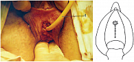 Рис. 5. Перемещенное наружное отверстие уретры и ушитая рана влагалища: слева – фотография, справа – схема 