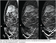 Рис. 4. Пациентка И. Дуктограмма молочной железы, внутрипротоковые разрастания.  2D- (A) и 3D-изображение (B, C – послойные)