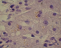 Рис. 6. Внутриклеточный холестаз в отдельных гепатоцитах