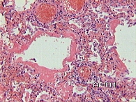 Рис. 4. Больной П.: гиалиновые мембраны в альвеолах, лимфоидная инфильтрация межальвеолярных перегородок, полнокровие сосудов, очаговое кровоизлияние. Окраска гематоксилином и эозином. ×100.