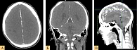 Рис. 4. Кальцификация серпа мозга и намета мозжечка: А, Б – у мужчины 45 лет;  В – у женщины 32 лет (собственные наблюдения)