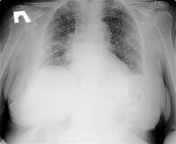Рис. 1. Рентгенологическая картина диссеминированного процесса в паренхиме обоих легких