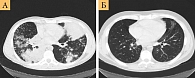 Рис. 3. Результаты компьютерной томографии, показывающие регрессию метастазов в легкие  на химиотерапии пеметрекседом и бевацизумабом: январь 2010 (А), декабрь 2013 (Б)