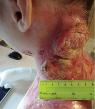 Рис. 4. Прогрессирование плоскоклеточного рака кожи боковой поверхности шеи верхней трети спины
