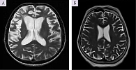 Рис. 1. Сравнительная характеристика МРТ пациента с ФТД (А) и пациента с умеренными когнитивными нарушениями вследствие хронической ишемии головного мозга (Б)