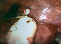 Рис. 2. Диагностическая лапароскопия: генитальный эндометриоз у девочек с пороками развития половых органов