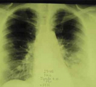 Рис. 1. Рентгенография 2 июля 2010 г. Массивная инфильтрация в средних и нижних отделах обоих легких