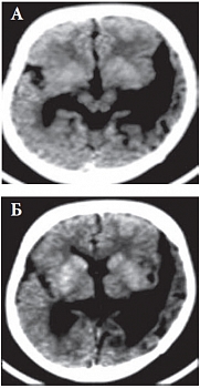 Рис. 2. А, Б. РКТ головного мозга больного К., 5 лет. Порок развития головного мозга. Двусторонняя шизэнцефалия (сомкнутая справа и разомкнутая слева)