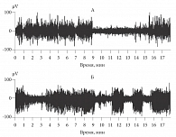 Рис. 1. Электроэнцефалограмма кролика: А – периоды медленного сна и бодрствования; Б – имитация дельта-волн сна зрительной стимуляцией в состоянии активного бодрствования