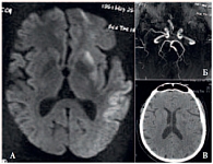 Рис. 5. Данные визуализационного исследования головного мозга пациента Х., 62 года: а – магнитно-резонансная томография; б – магнитно-резонансная ангиография, в – рентгеновская компьютерная томография