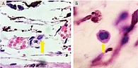 Рис. 2. Клетки опухолевого микроокружения меланомы хориоидеи: плазмоцит (А; ×400), промиелоцит (Б; ×400) (указаны желтой стрелкой, окраска гематоксилином и эозином)