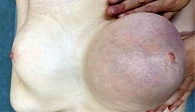 Рис. 1. Правая молочная железа пациентки N. (вид спереди)