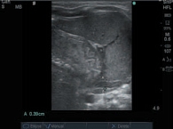 Рис. 2. УЗИ левого надпочечника мальчика в возрасте 1 мес. 1 день, родившегося на 25-й неделе гестации (диагноз: врожденная пневмония, бронхолегочная дисплазия), поперечное сечение надпочечника: измерение толщины органа (А)