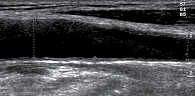 Рис. 2. Дуплексное сканирование брахиоцефальных артерий пациента Л. от 18.01.2016
