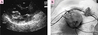 Рис. 4. Эхинококковая киста сердца: ЭхоКГ (А), макропрепарат с элементами иссеченного митрального клапана (Б)