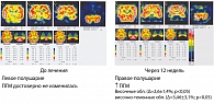 Рисунок 6. Динамика состояния перфузии головного мозга на фоне 12-недельной терапии препаратом Конкор