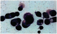 Рис. 1. Опухолевые клетки рака яичника с признаками секреции в виде венчика тонких волоконец с одного полюса, подобно ресничкам. Окрашивание  по Паппенгейму, увеличение в 400 раз