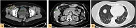 Рис. 8. КТ с в/в контрастированием от марта 2023 г.: А – органов грудной клетки; Б – органов брюшной полости;  В – органов малого таза