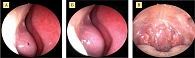 Рис. 2. Эндоскопические изображения полости носа и задней стенки глотки во время исследования перемещения частиц-метчиков (А – 0 минут наблюдения, Б – 3 минуты наблюдения, В – 12 минут наблюдения)