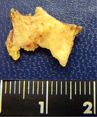 Рис. 3. Кость, извлеченная из левого нижнедолевого бронха больного Б.