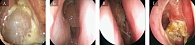 Рис. 1. Эндоскопическая картина полости носа при хроническом риносинусите с назальным полипозом: гнойные выделения (А), бесцветные (Б), вязкие (В), в виде корок (Г)