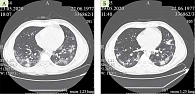 Рис. 2. Компьютерная томограмма легких пациента С. в динамике:  А – от 23 мая 2020 г.: картина двусторонней полисегментарной вирусной пневмонии, в том числе COVID-19; Б – от 29 мая 2020 г.: положительная динамика течения вирусной пневмонии