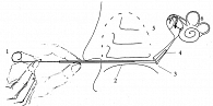Рис. 2. Схематическое изображение удаления проводника из микрокатетера, установленного в устье слуховой трубы (1 – проводник, 2 – нижний носовой ход, 3 – устье слуховой трубы, 4 – микрокатетер, 5 – барабанная полость, 6 – внутреннее ухо)