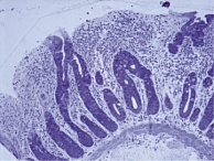 Рис. 1. Полная атрофия кишечных ворсинок (Marsh 3с – тотальное уплощение ворсинок), окраска толуидиновым синим. Целиакия – острый период забол