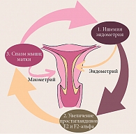 Схема патогенеза первичной дисменореи