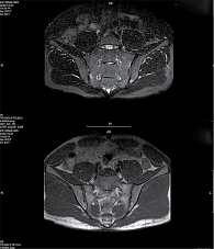 Рис. 6. Магнитно-резонансная томограмма КПС пациента И. в режиме STIR исходно (визуализируются очаги активного воспаления с двух сторон на фоне двусторонней жировой дегенерации и единичных эрозий в режиме Т2)