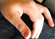 Рис. 6. Моцерированный палец