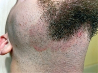 Рис. 2. Высыпания себорейного дерматита на коже бороды и усов с формированием инфильтрации и выраженным зудом