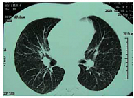 Рис. 4. Клинический случай 1. Положительная динамика при РКТ после 6 месяцев терапии преднизолоном по 30 мг в день и витамином E у больного саркоидозом