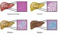 Рис. 1. Прогрессирование стеатоза в цирроз – изменения гистологической картины ткани печени