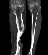 Рис. 4. Рентгенологическая картина деструкции нижней трети большеберцовой кости (фронтальный срез)