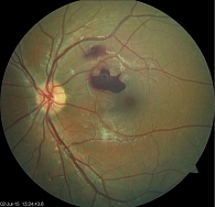 Рис. 1. Больной З., 29 лет: острый миелобластный лейкоз, офтальмоскопическая картина левого глаза, крупные ретинальные кровоизлияния