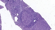 Рис. 3. Выраженная диффузная лимфоцитарная инфильтрация, формирование ложных долек. Активный цирроз печени. METAVIR A2F4